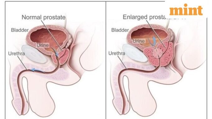 prostate_1779384854655_1779384898553_75376313-8844-4b16-996f-59a83f27ab3e.jpg